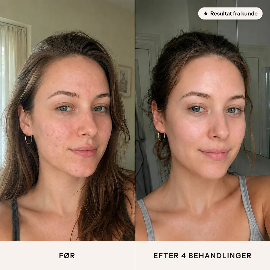 Før og efter 4 behandlinger med Feevra Microneedling Pen – resultat fra kunde